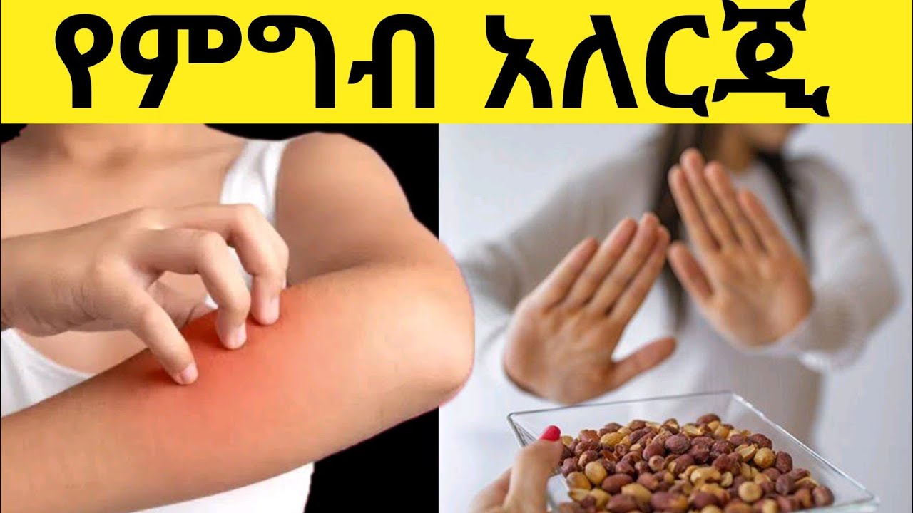 የምግብ አለርጂ ምንድነው ? | ምልክቶቹ ፣ መንስኤዎቹ እና መፍትሄዎቹ
