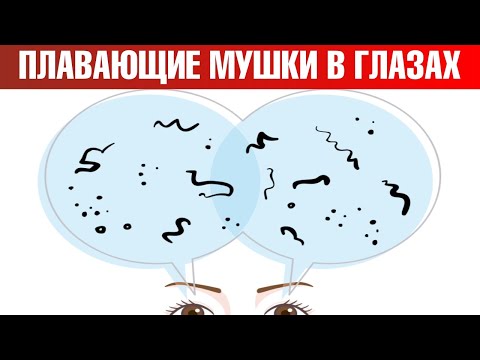 Как избавиться от мушек в глазах? Мушки перед глазами: причины🧐