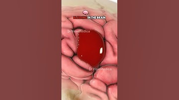 Burr hole drainage (3D Animation)