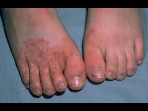 foot infection pictures