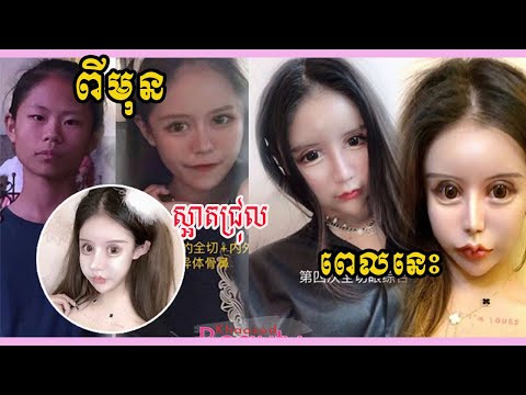 ញាក់សាច់! ទៅវះកាត់កែសម្ផស្ស ១០០ ដង តាំងពីអាយុ ១៣ ឆ្នាំ ឥលូវបានលទ្ធផលស្អាតជ្រុល…