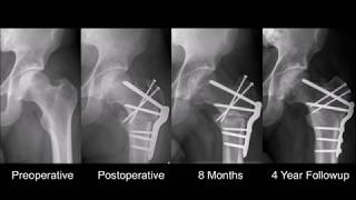 K. Siebenrock, First results of open treatment of AVN with a CHL, Hip Symposium 2018