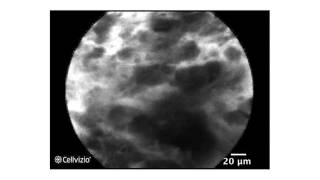 Seeing Cancer With the World's Smallest Microscope at MUSC