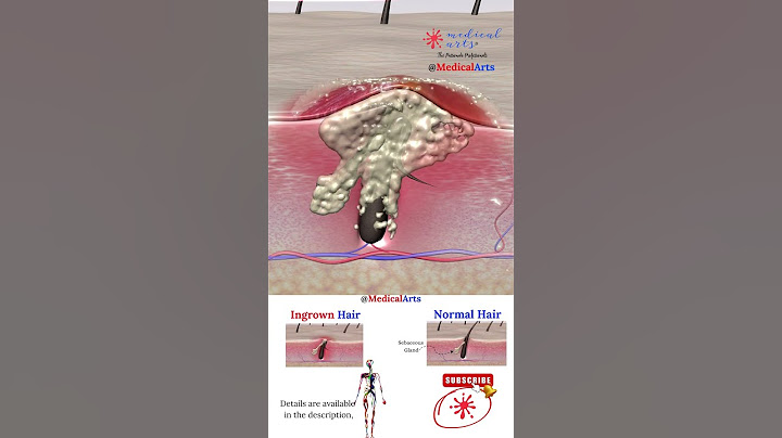 Ingrown Hair ⨖ Laser Treatment ⨕ Medical Arts 3D Animation