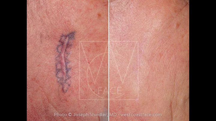 Scar Revision & Skin Cancer Treatments Services in...