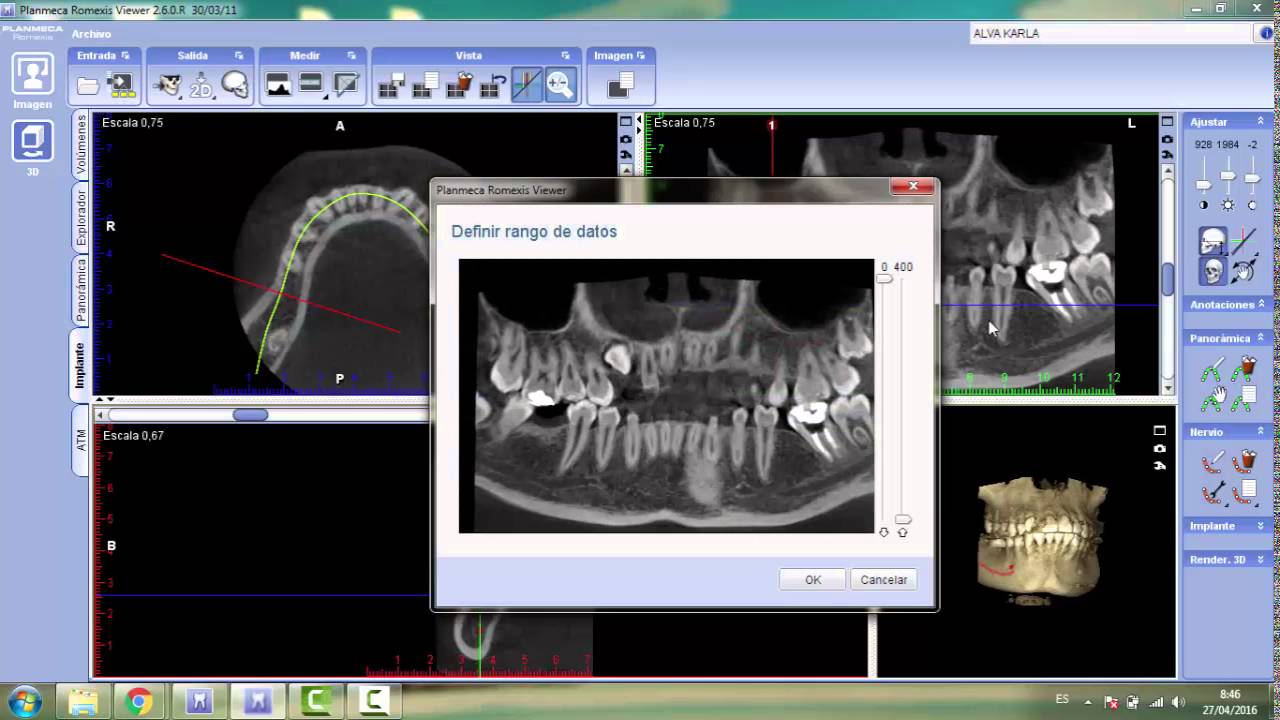 PLANIFICACIÓN PARA IMPLANTES: ROMEXIS. PLANMECA