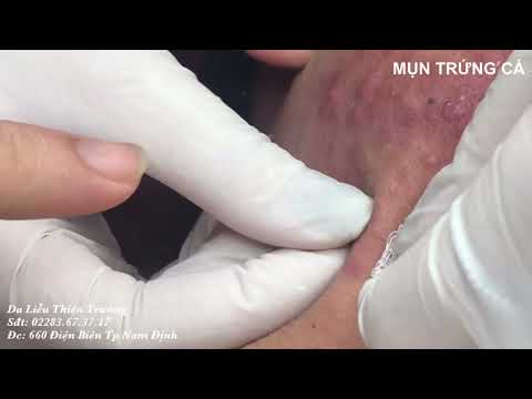 Video Điều trị mụn trứng cá, mụn ẩn, mụn viêm nhanh chóng và... - youtube
