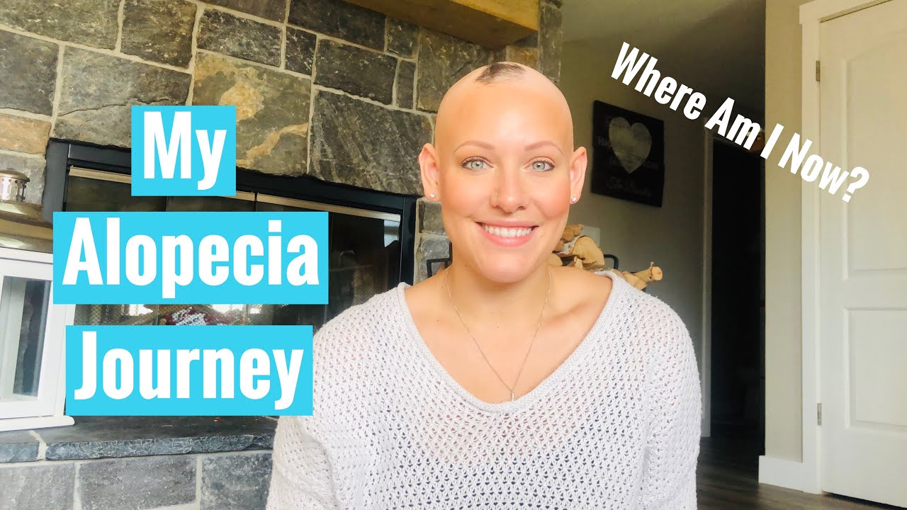 My Alopecia Journey || Living with Alopecia