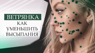 ВЕТРЯНКА У ВЗРОСЛЫХ / КАК Я УМЕНЬШИЛА ВЫСЫПАНИЯ И БЫСТРО ВЫЛЕЧИЛАСЬ