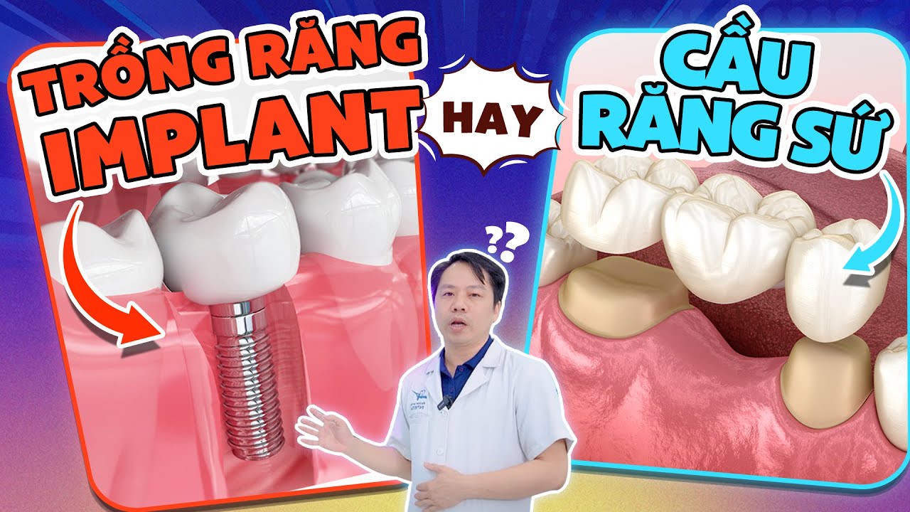 Outline Video Nên Làm Cầu Răng Sứ Hay Trồng Implant? Chỉ 3 Phút Đầu Video Đủ Để Quyết Định!