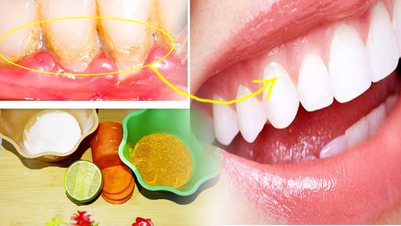 Teeth Whitening Just 3 Minute at Home How to teeth whitening fast at