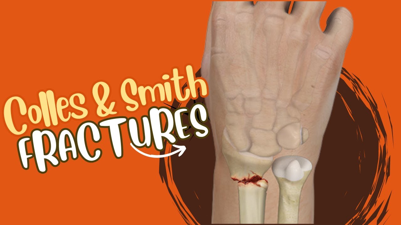 colle-s-smith-fractures-upper-limb-trauma-youtube