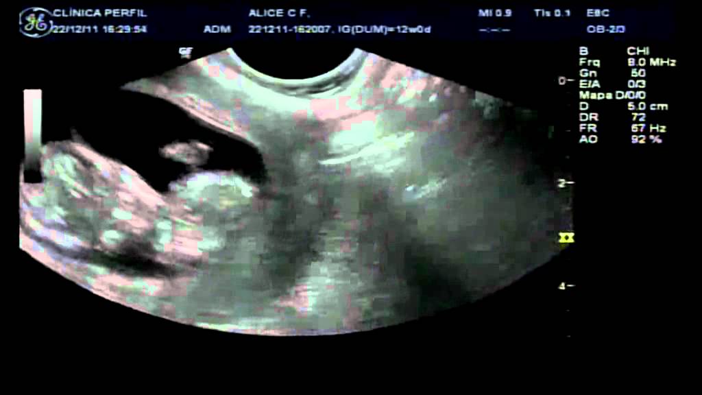 Ecografia Nr3 3 Meses Bebe Da Alice E Do Carlos Mexe Na Barriga Trasnlucencia Nucal Normal Youtube