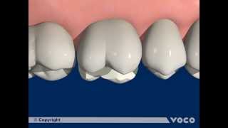 Universal adhesive Futurabond U-Part 11/12: Indirect restoration with a DC/CC luting composite