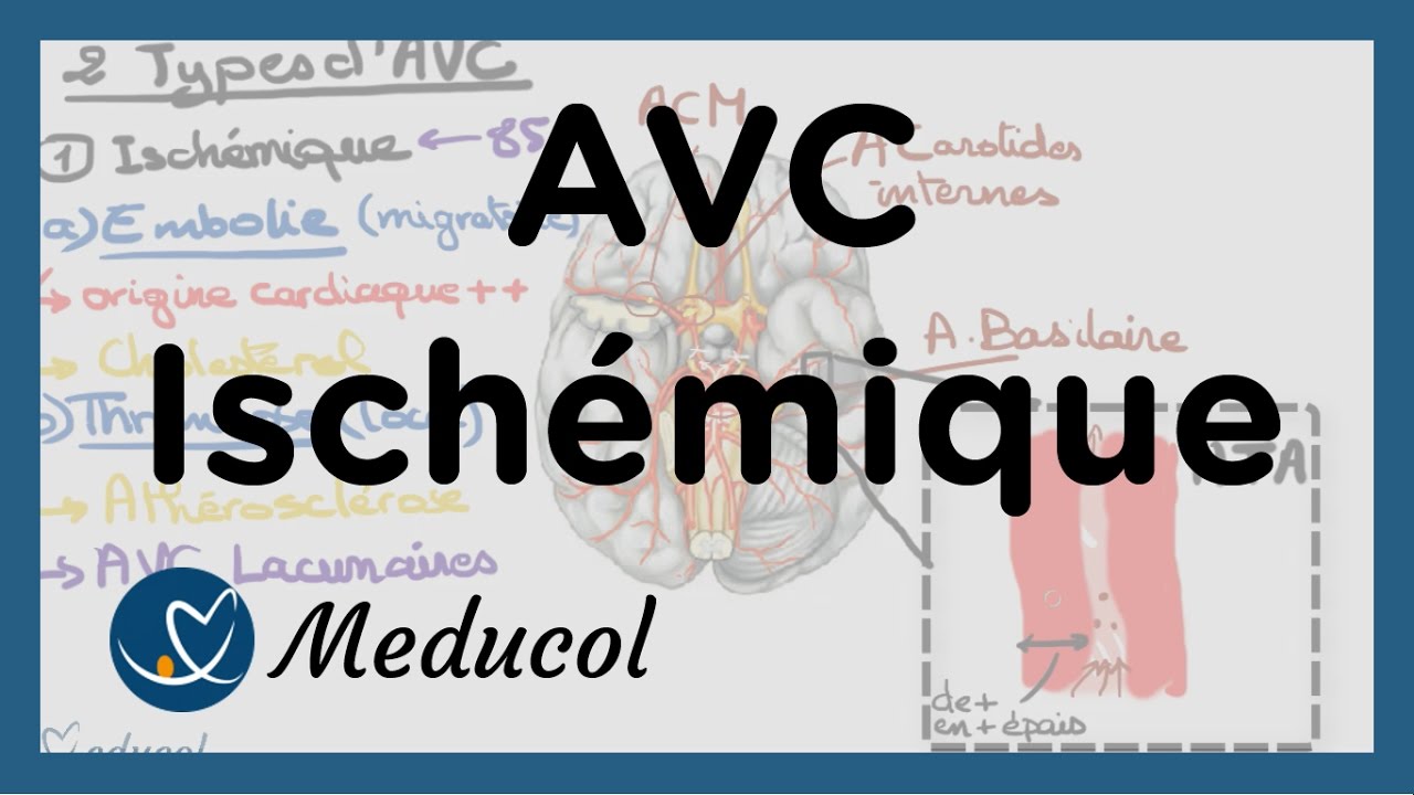 AVC ischmique causes embolie crbrale AVC thrombose et AVC jonctionnel