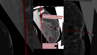Breast metastasis screening mammogram