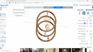 3D Surgery using Tabplan3D - Tibial Shaft Deformity - Simulated Fixation using Ilizarov Fixator