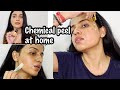 CHEMICAL PEEL AT HOME | How To Do Chemical Peel At Home | Chemical Peel Treatment India