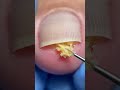 #nailcare #pedicure #satisfying #nailtech #footcare #oddlysatisfying #fyp