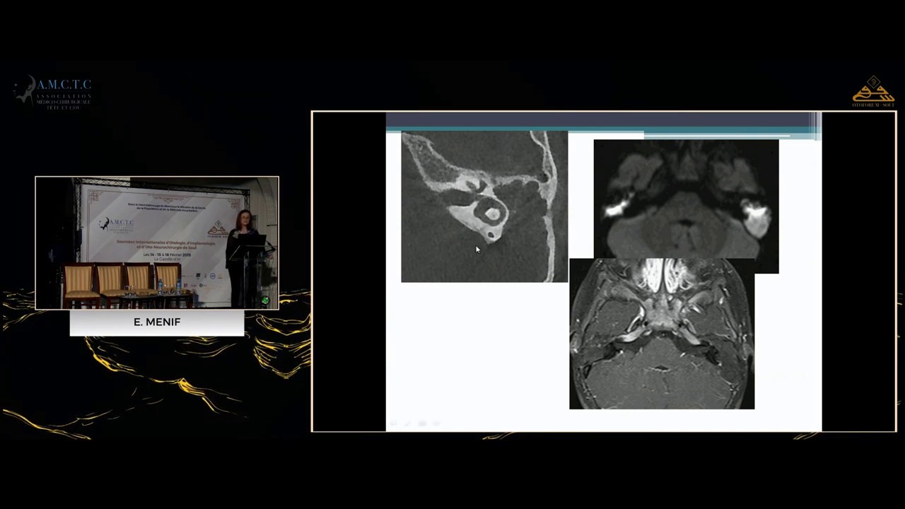 Vidéo de Conférence : Pr Emna Menif : Imagerie du Cholestéatome