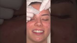 Satisfying Pore Extractions: Clear Your Clogged Pores! #shorts