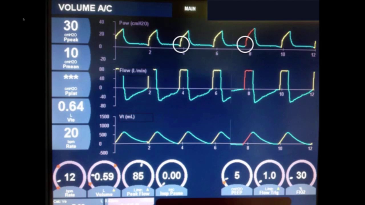 Principles of Mechanical Ventilation Part 1 YouTube