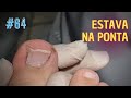 ESTAVA NA PONTA ( "NAIL LOVERS" )#PODOLOGOMAURELIO #PODOLOGIA#UNHAENCRAVADA