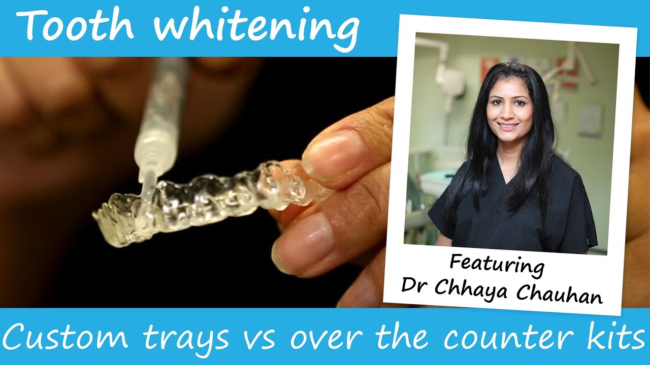 Whitening trays vs over the counter whitening kits YouTube