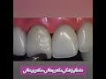 ترمیم و بازسازی واصلاح بد رنگی دندان سانترال ترمیم و بازسازی واصلاح بد رنگی دندان سانترال