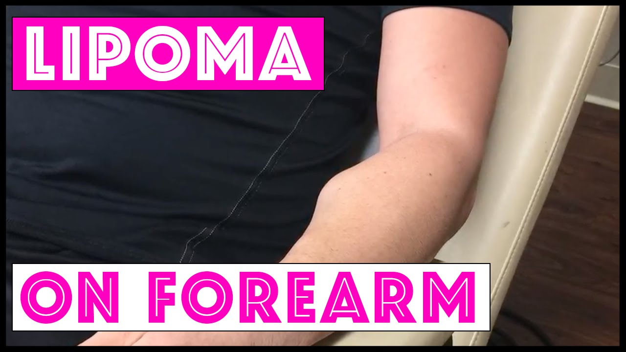 Excision of large lipoma on forearm - YouTube