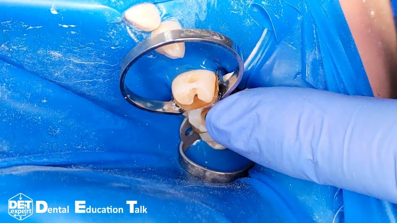 Стратегия в фиксации матриц кольцами Tor-VM на 15 и 16 класс II - DET.expert & Tor-VM 4K