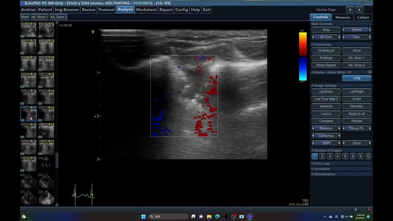 5504 TFAST HEPATOMA ,PDH, ICTERUS ,INTRAHEPATOLITHIOSIS, ECHOPAC ,CAT,ICTERUS, PDH,LUNG THORAX