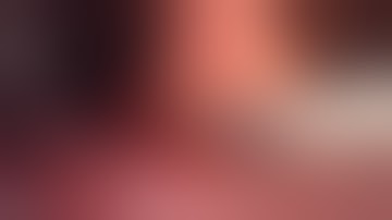 Laparoscopic endoscopic assisted "Hybrid" resection of a gastric antral lesion