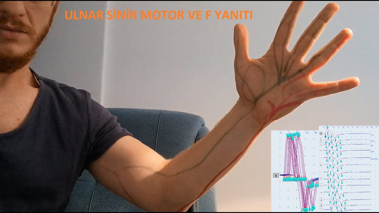 ulnar