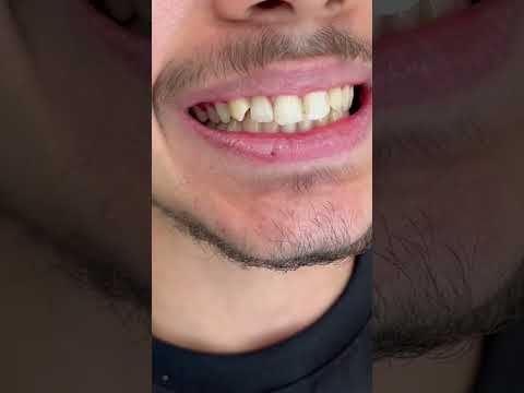 بدون تراش دندونای سفید و براقی داشته باش کامپوزیت  دندانپزشکی دندان زیبایی ایمپلنت ونیر