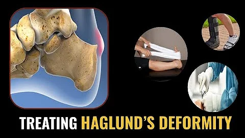 How to TREAT Haglund's Deformity? (Home Treatments...