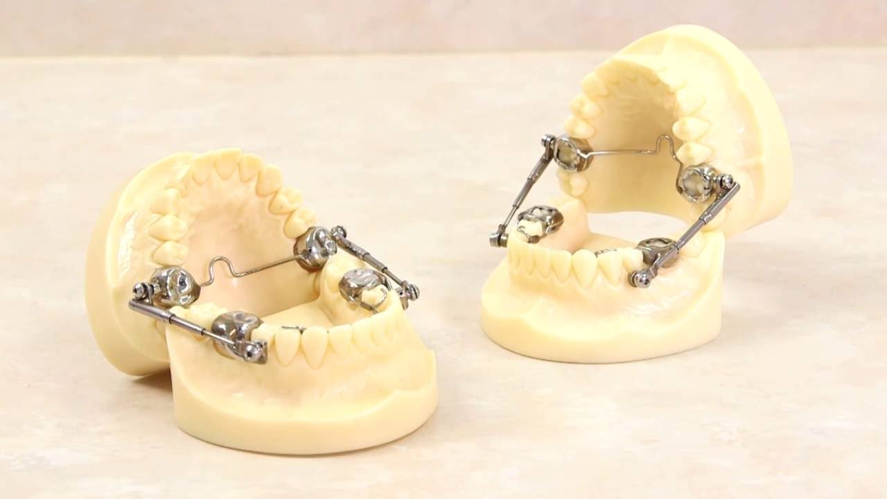 Making a Herbst Appliance YouTube