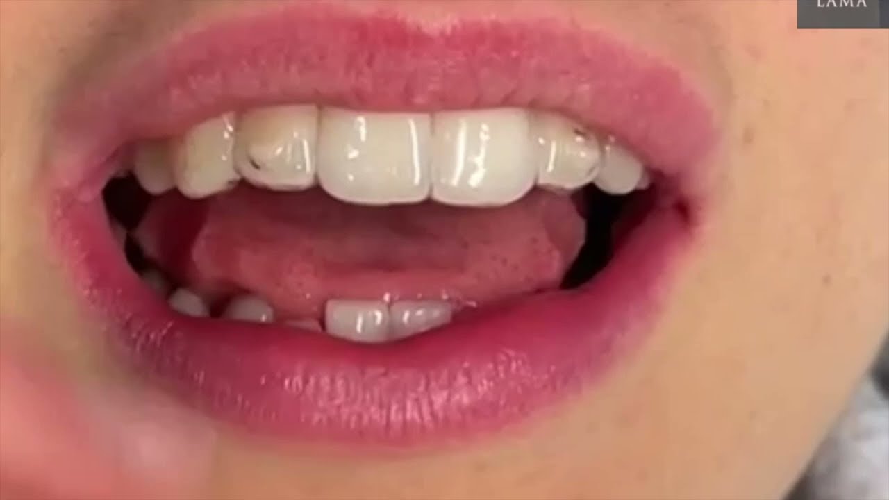 Allineatori Trasparenti - Studi Dentistici Lama