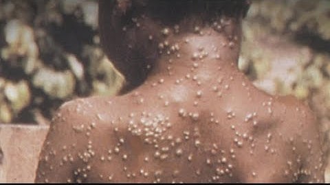 CDC asks travelers to mask up due to monkeypox