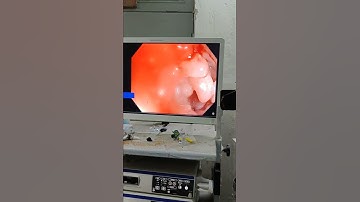 pseudopolyps in a patient with ulcerative colitis