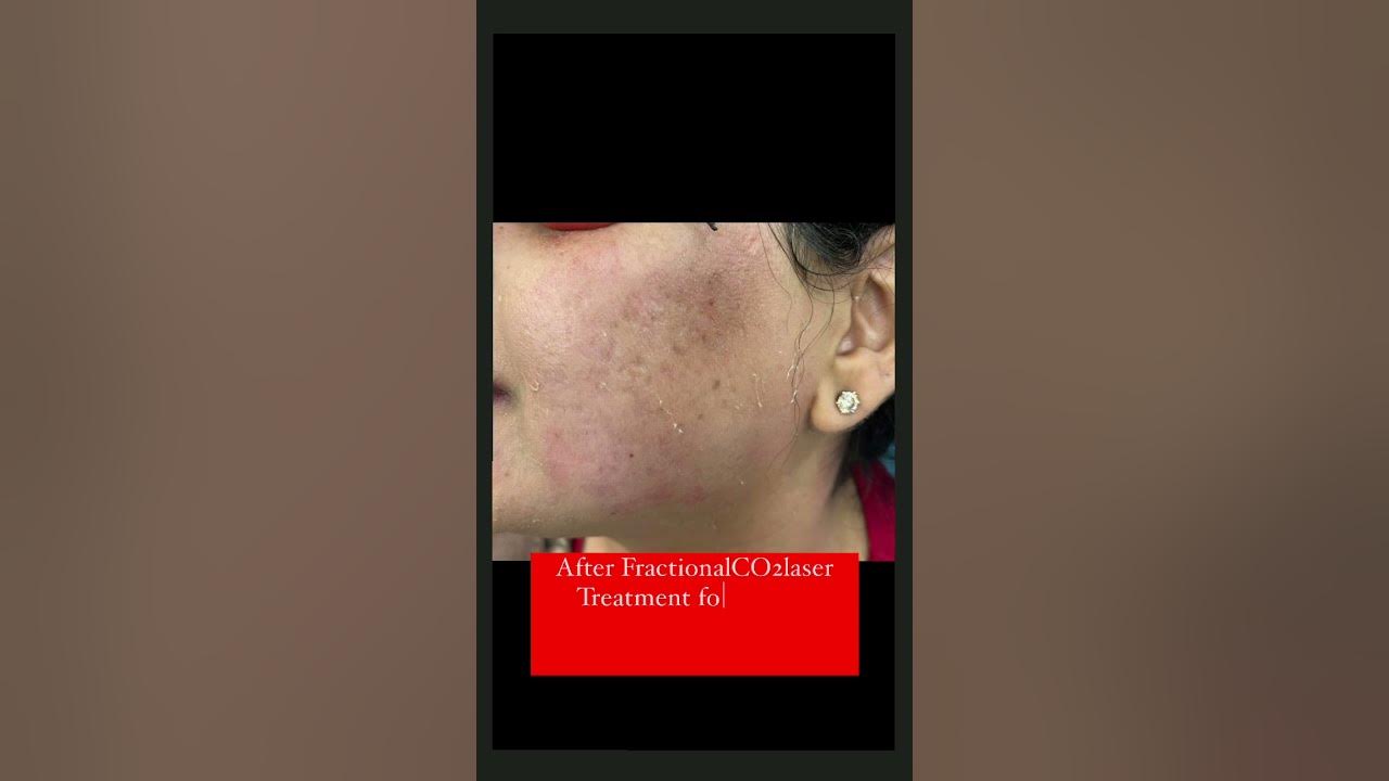 FractionalCO2laser Treatment for Steroid injections induced atrophy