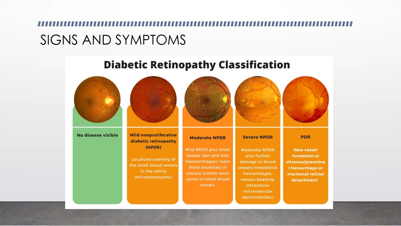 Diabetic Retinopathy in Pregnancy