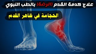 علاج كدمة القدم ( الرضة ) بالطب النبوي - الحجامة في ظاهر القدم | للشيخ عبدالرزاق البدر