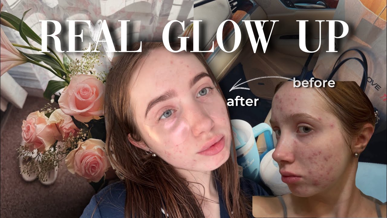 5 ЛЕТ АКНЕ / жизнь и правда в США