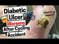 This Is What Happens To Diabetic Ulcers After an Accident!
