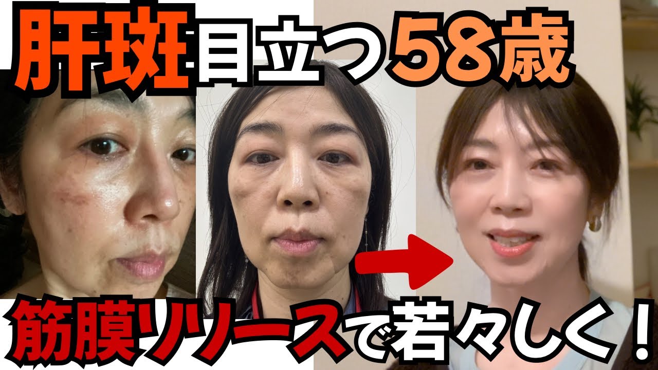 しぶとい肝斑が薄くなってる！？首元の筋スジも解消？筋膜リリースと食事法でどこまで変わる？