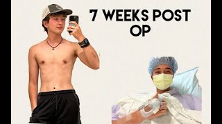 Keyhole Ftnb Top Surgery With Dr.mosser 7 Weeks Post Op At 16 Years Old.