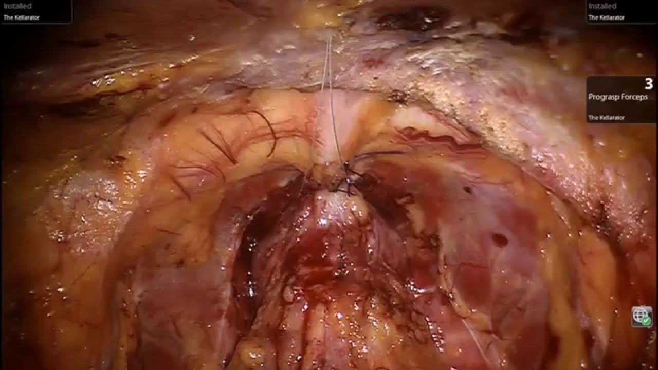 Robotic prostatectomy Full Case Step by Step with Expert Surgeon - YouTube