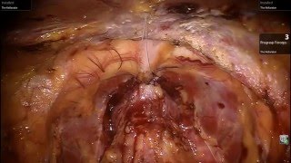 Robotic prostatectomy Full Case Step by Step with Expert Surgeon