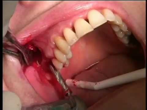 شاهد عملياً كيف تتم زراعة الأسنان ……… مهارات طب الأسنان
